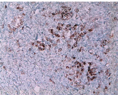 Figure 2.  (C)  Scattered  anaplastic  large  transformed