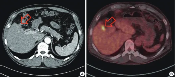 Fig. 2 . Gross finding of the specimens showed ill-defined yellow to brownish, variegated, nodular lesions (arrows) without necrosis in the liver  (A) and the transverse colon (B).