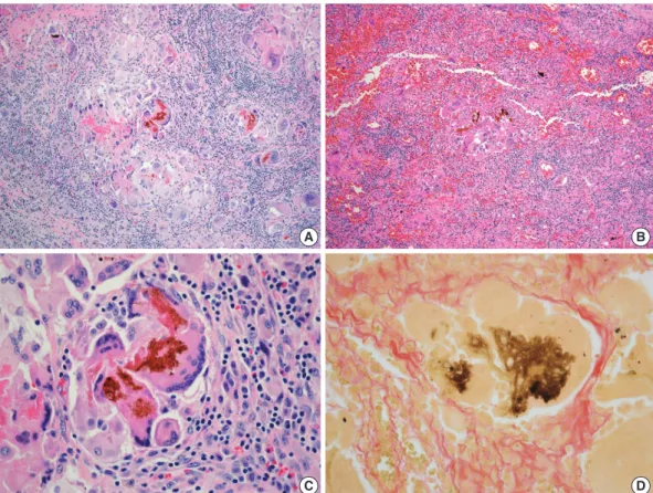 Fig. 3. Microscopic findings of the lesion. The liver (A) and transverse colon (B) showed granulomatous inflammation, which consists of brown  pigments and multinucleated giant cells with numerous lymphocytes (C)