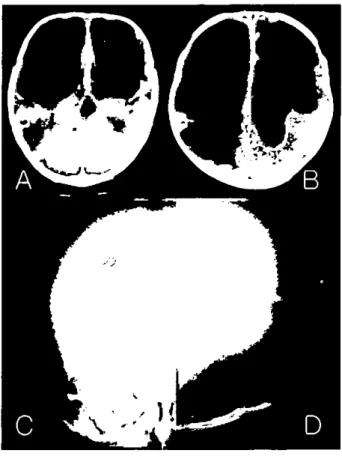 Figure 2. Mter revision. X-ray showed newly inscrted ventricular catheter and floating ventricular catheter (.π'Ow) which had been inserted first shunting operation