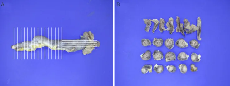 Fig. 1. Sectioning and extensive examination the fimbriated end protocol. (A) A fallopian tube demonstrating longitudinal sectioning of  the fimbria and extensive cross-sectioning of the remainder of the tube at 2–3-mm intervals and (B) preparing cross-sec
