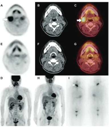 Figure 1.  18 F-FDG  PET/CT  as  a  routine  follow-up