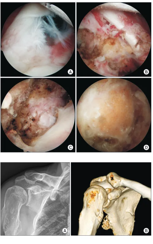 Fig. 3. Arthroscopic images: (A) The pe- pe-dunculated osteochondroma protrude into  rotator interval