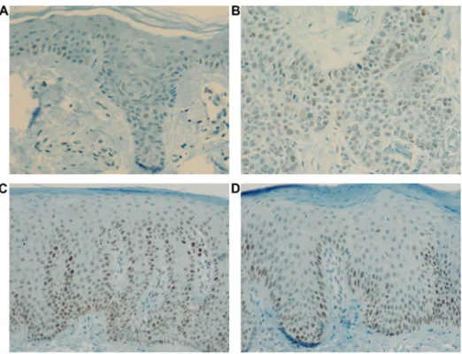 Figure 4. p53 WT  expression. p53 WT  expression in (A) control, (B) SCC, (C) acute psoriasis, and (D) chronic psoriasis groups