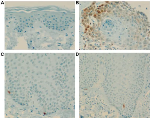 Figure 5. p16 expression. p16 expression in (A) control, (B) SCC, (C) acute psoriasis, and (D) chronic psoriasis groups