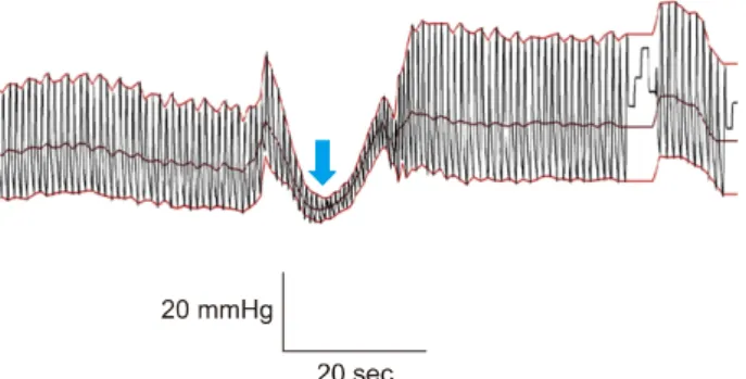 Fig. 4. Abnormal Valsalva response (2). When blood pressure (BP) increase does not increase over the baseline during late phase II (arrowhead) or phase IV (arrow) or pressure recovery time (PRT)  is prolonged over 5 seconds, we can interpret this as an adr