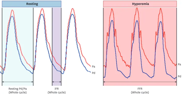 Figure 1. Resting and hyperemic pressure-derived invasive physiologic indices. Resting Pd/Pa is measured during the entire cardiac cycle and iFR is measured  during “wave-free period” at resting status
