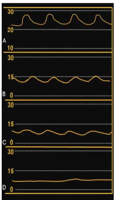 Figure 1. Illustration of epidural waveforms representing (A) strong, (B) moderate, (C) weak, and (D) absent