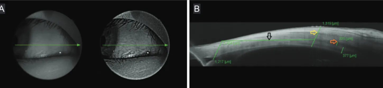 Fig. 1. Swept-source optical coherence tomography (SS-OCT) image from a 9-year-old boy