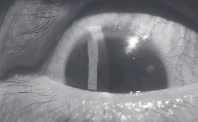 Fig. 1. Anterior segment photograph of the left eye taken 4 days after laser peripheral iridotomy (LPI)