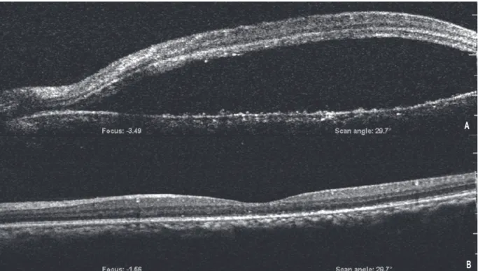 Fig. 3. Optical coherence tomography (OCT) of the left macula taken 4 days after LPI (A) shows hyporeflectivity  due to massive subretinal fluid accumulation; 2 weeks after focal laser photocoagulation (B), subretinal fluid  collection markedly decreased.