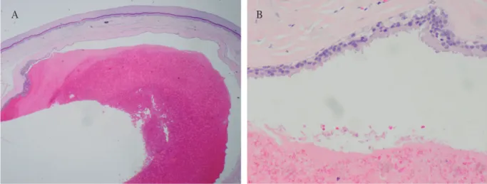Fig. 3. The granules are PAS-positive (A;PAS, ×100), resistant to diastase (B;DPAS, ×100) and CEA-positive  (C;CEA, ×100).