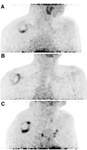 Fig. 2   Three recognizable patterns of increased  18 F-FDG uptake. a  AR dominant type