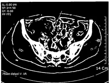 Figure 1. I1eal perforation cased by a suspected fish bone. I1eal wall thickening. an abscess in the cecal wall adjacent to i~ 뻐 d a suspected fish bone (밍 TOW) în the abscess are