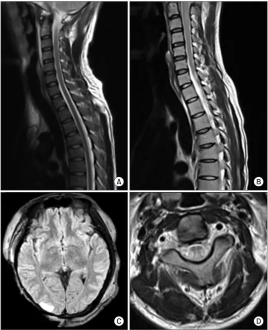 Fig. 2. (A, C) A cervical spinal mag- mag-netic resonance imaging (MRI)  taken 1 week after the injury  re-veals no specific findings, but a  brain MRI shows signal changes  in the right temporal lobe