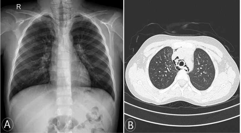 Figure 1.  Chest  radiography  at  the  time  of  admission  shows  subcutaneous  emphysema  in  the  neck,