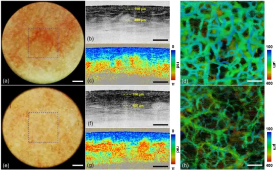 Fig. 6. Images of (a-d) PWS and (e-h) contralateral control by dermoscopy guided MF-OCT