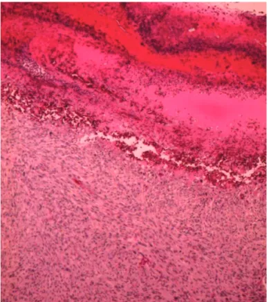 Figure 1.  Solitary  well-delimited,  rounded,  infiltrative