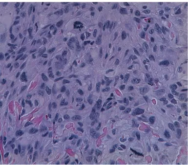 Figure 2.  (E)  Bizarre  nuclei  and  vesicular  cytoplasm-