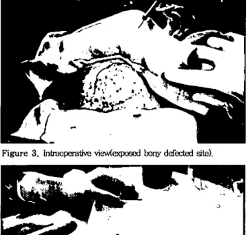 Figure 3. lntra 。며 -aöve view(exposed b 이 JYdefected site)