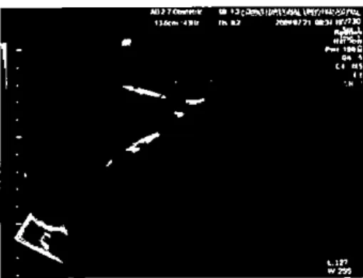 Figure 2. σaα1sabdominal sonograpy fmding