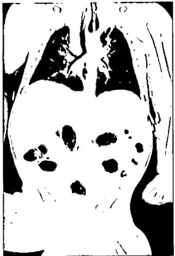 Figure 1. Chest computed tomography shows dilated proximal esophagcal pouch wiili gastric tube