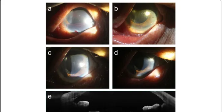 Fig. 2 Postoperative slit-lamp examination and tomographic image. a Bleeding from the torn root of the iris at 1 week postoperatively