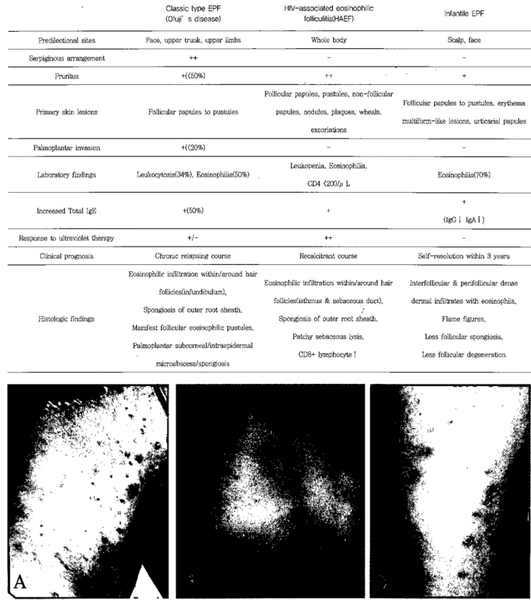 Table 1. Clinical differences between 야 rree subtypes of eosinophilic pustular folliculitis(EPF)