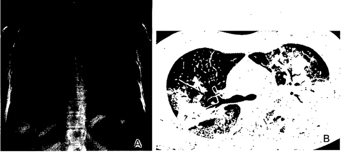 Figure 1. Pulmonary tuberculosis in a 24-year-old wom 밍 1.