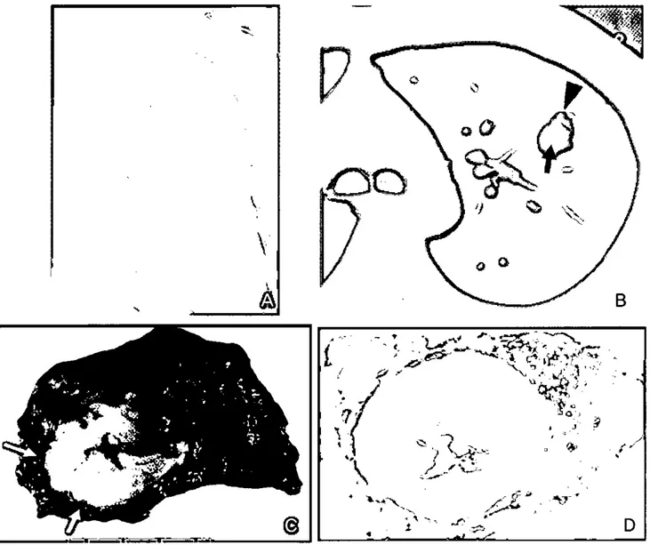 Figure 6. Tubercu10ma in a 41-year-old man. (Courtesy: Kyoung s ∞ Lee. MD. of sam 밍 mg Medical Center