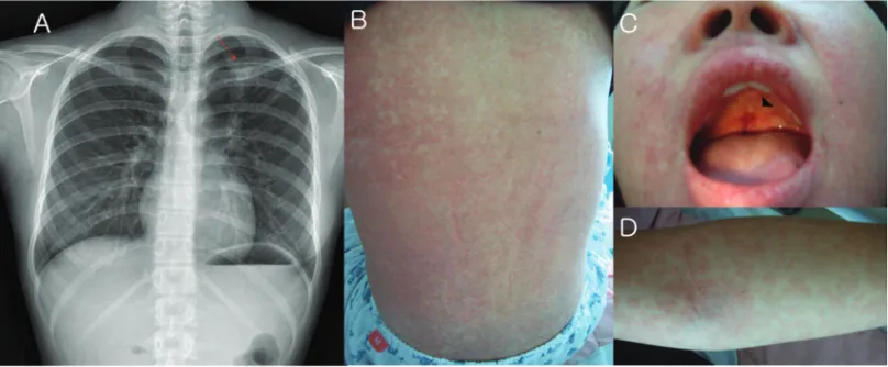 Figure 1. A.Chest radiograph that indicates presence of active TB on left upper lung (red arrow)