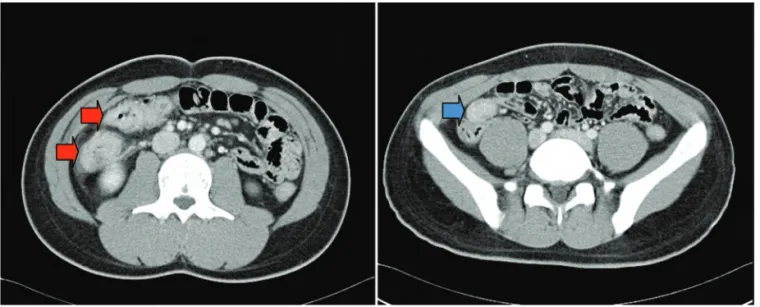 Figure 2. Contrast-enhanced  CT  scan  showed  segmental  enhancing  wall  thickening  in  the  (A)  ascending  colon,