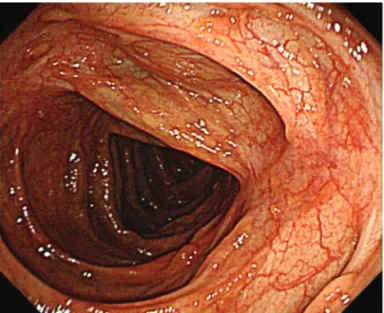 Figure  4.  Colonoscopy  showed  several  longitudinal  ulcer