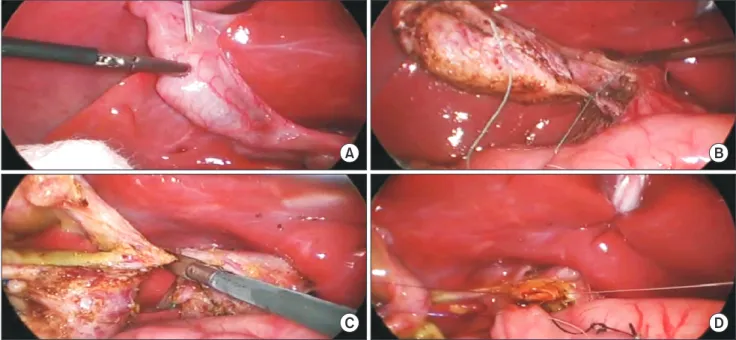 Fig. 2. The laparoscopic operating field. (A) Intraoperative cholangiography. (B) Ligation of distal CBD