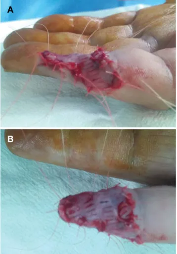 Figure 1.  Preoperative injury site image (A: Right hand 5 th  finger 
