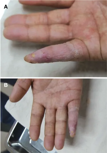 Figure 3.  Image 3 months after operation (A: Right hand 5 th  finger 