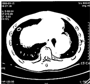 Figure 1. CT scan displaying fluid-filled cyst and adjacent uncomplicated cyst in left lower lobc