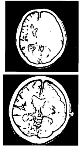 Figure 1. At first operation. A: Preoperative computed tomography(CT) showing layerd density chronic subdural hemaloma(= 에 having liqu ，퍼 ed hemaloma 밍 1d midline 양파비 Jg