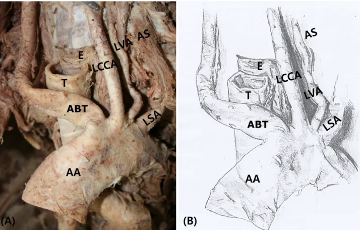 Fig. 1. Photograph (A) and schematic drawing (B) of the variation in the aortic arch. An aberrant brachiocephalic trunk (ABT) originated from the aortic arch (AA) at the left side of the trachea (T)