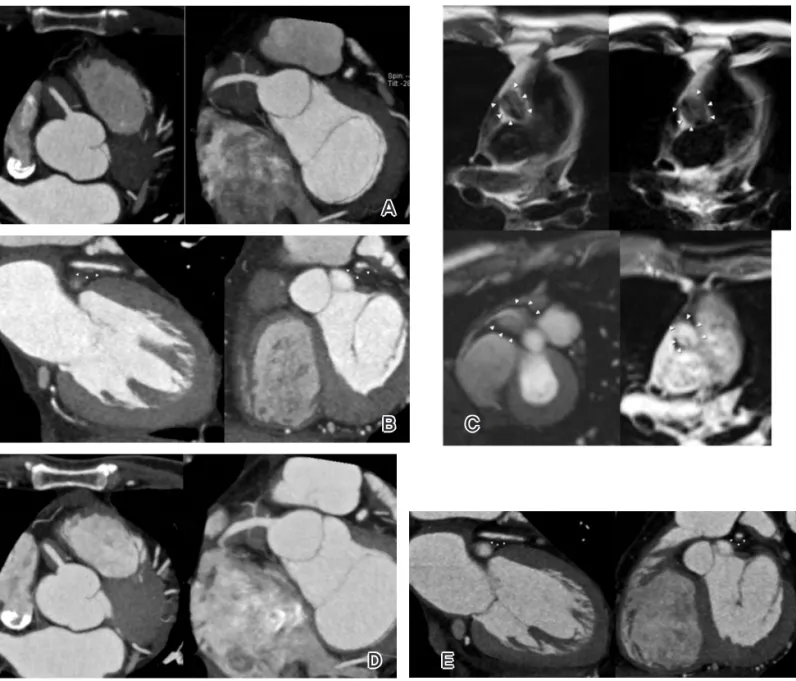 Figure 1. A 54-year-old man with presumed IgG4-related coronary periarteritis.