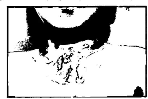 Figure 1. Secondary degree supe 버 cial bum if\iury.