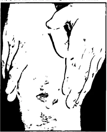 Figure 2. Subepidermal blister with mild inflammatory cellular infiltrates in upper dennis(H &amp; E