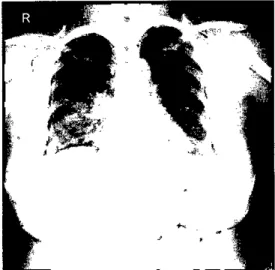 Figure 1. The ehest X-ray showed patchy consolidation in the right middle lung zone due to aspiration