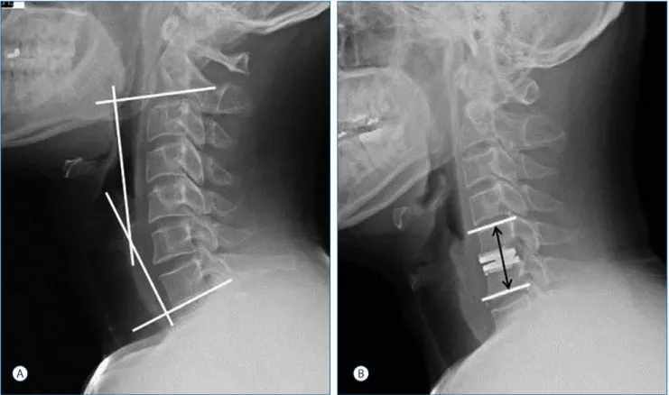 Fig. 1. A : Sagittal balance was measured as the angle between the lower margin of C2 and C7 on a static neutral lateral radiograph