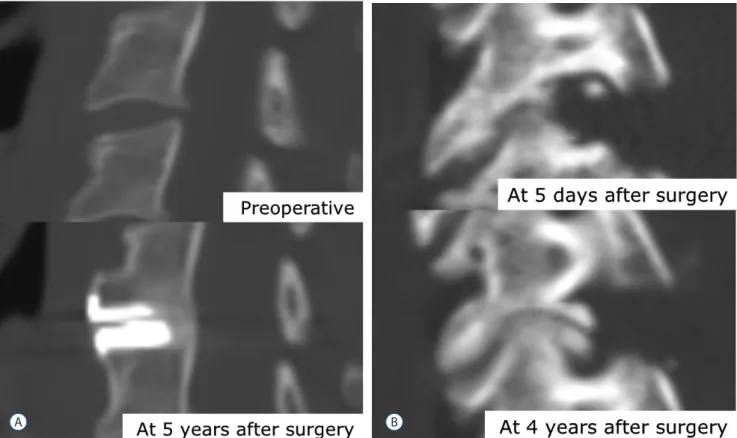 Table 4. Long-term outcomes after the operation