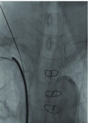 Figure 2. Chest radiograph showing the puncture of the right  internal jugular vein.