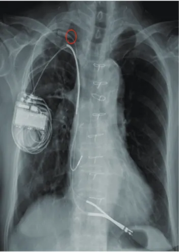 Figure 3. Chest radiograph showing the implanted lead con- con-figuration. Location of the puncture site of the right internal  jugular vein (circle).