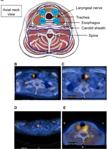 Figure 1 Schematic presentation of location of parathyroid adenomas in relation  to the trachea (A) and examples of patients with perfect correlation with the  intraoperative findings (B–E).