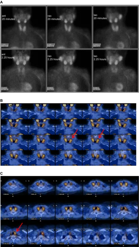 Figure 2 A nonlocalizing parathyroid scan with an enlarged multinodular thyroid gland
