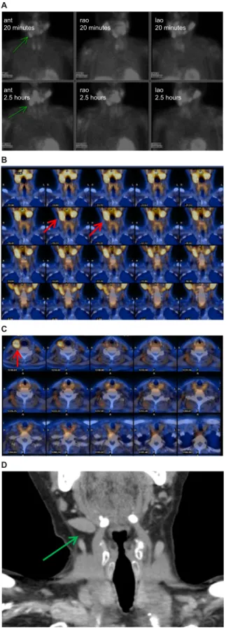 Figure 3 A patient with an enlarged right submandibular gland which was misleading  as an ectopic right parathyroid adenoma on the SPS (A–C) and 4D CT scan (D)